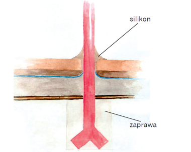 Schemat: Właściwe ukształtowanie silikonowego uszczelnienia wokół słupka balustrady